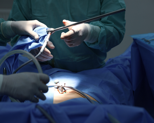 Laparoscopy